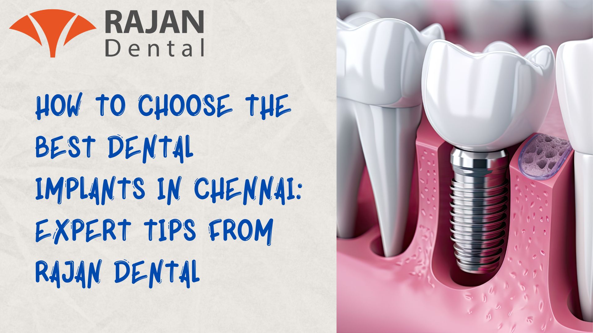Expert Tips: Choosing the Best Dental Implants in Chennai
