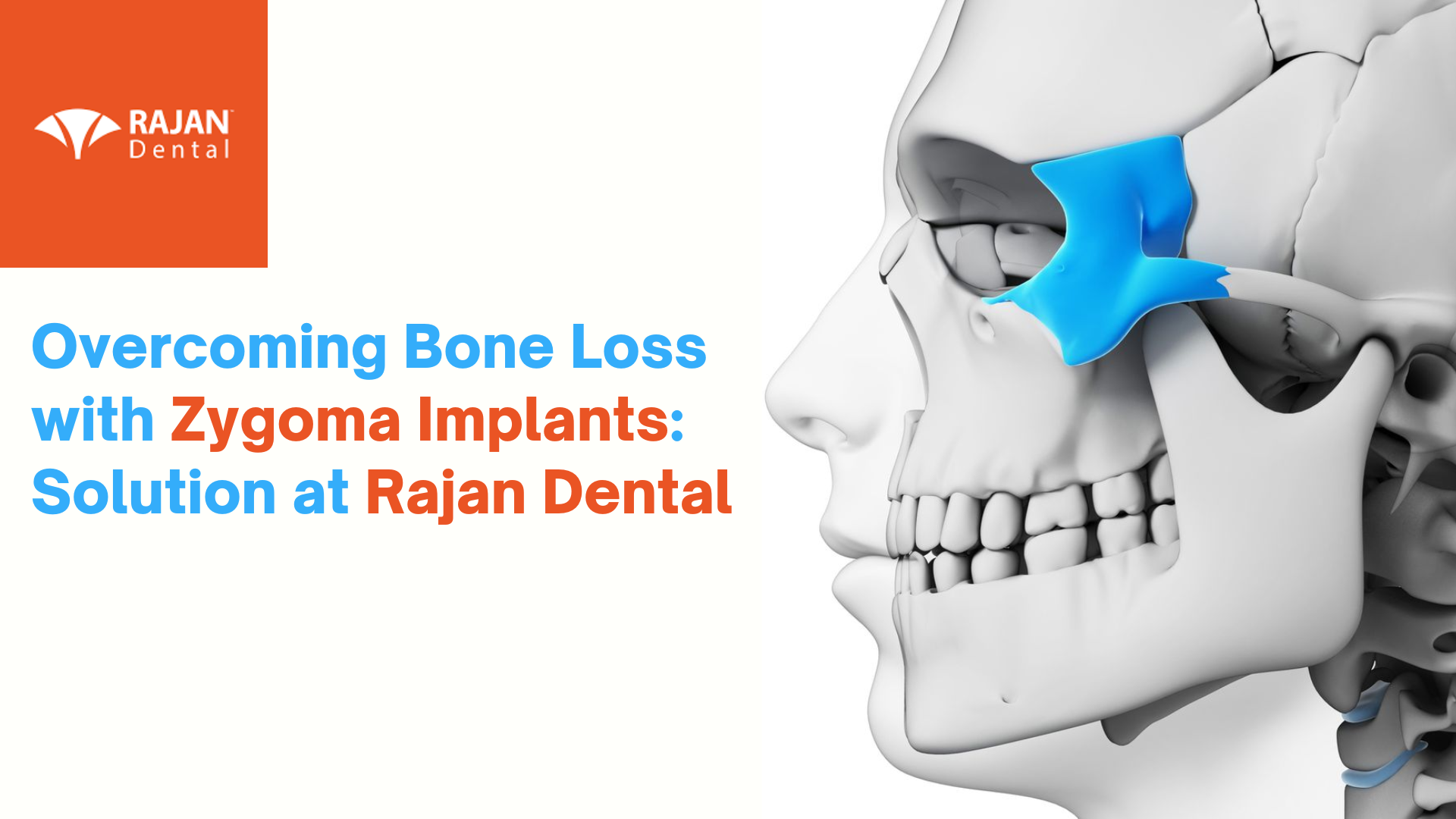 Overcoming Bone Loss with Zygoma Implants: Solution at Rajan Dental