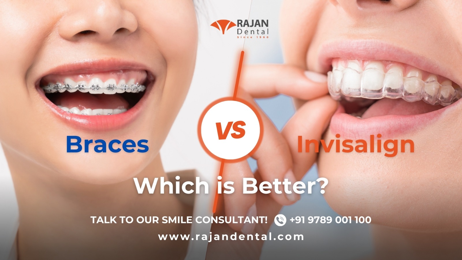 Top Benefits of Choosing Invisalign Over Braces