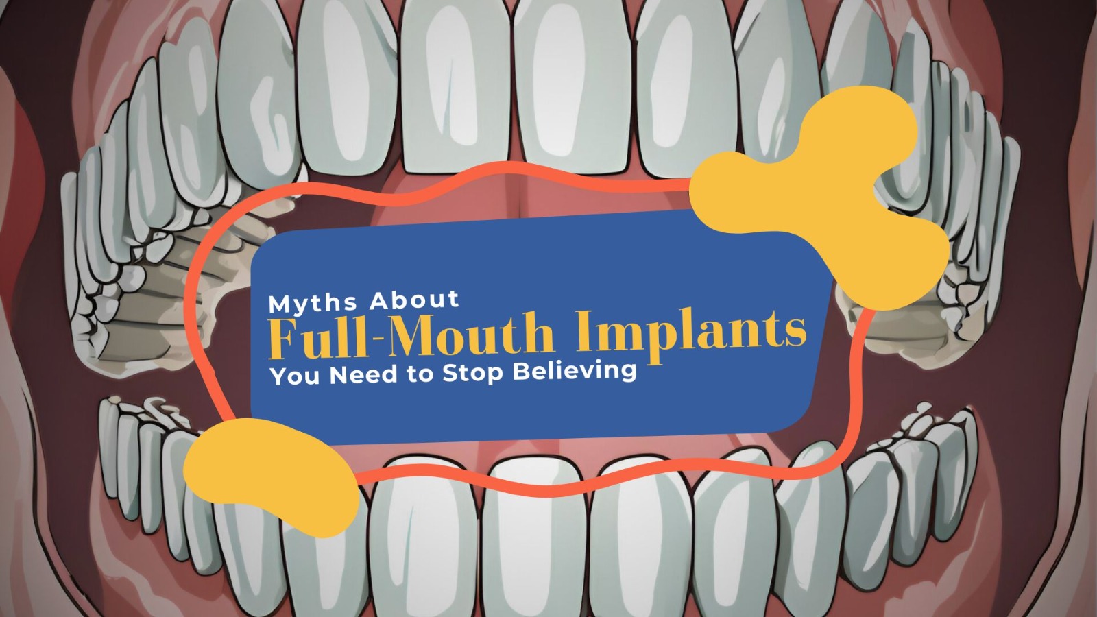 Myths About Full-Mouth Implants You Need to Stop Believing