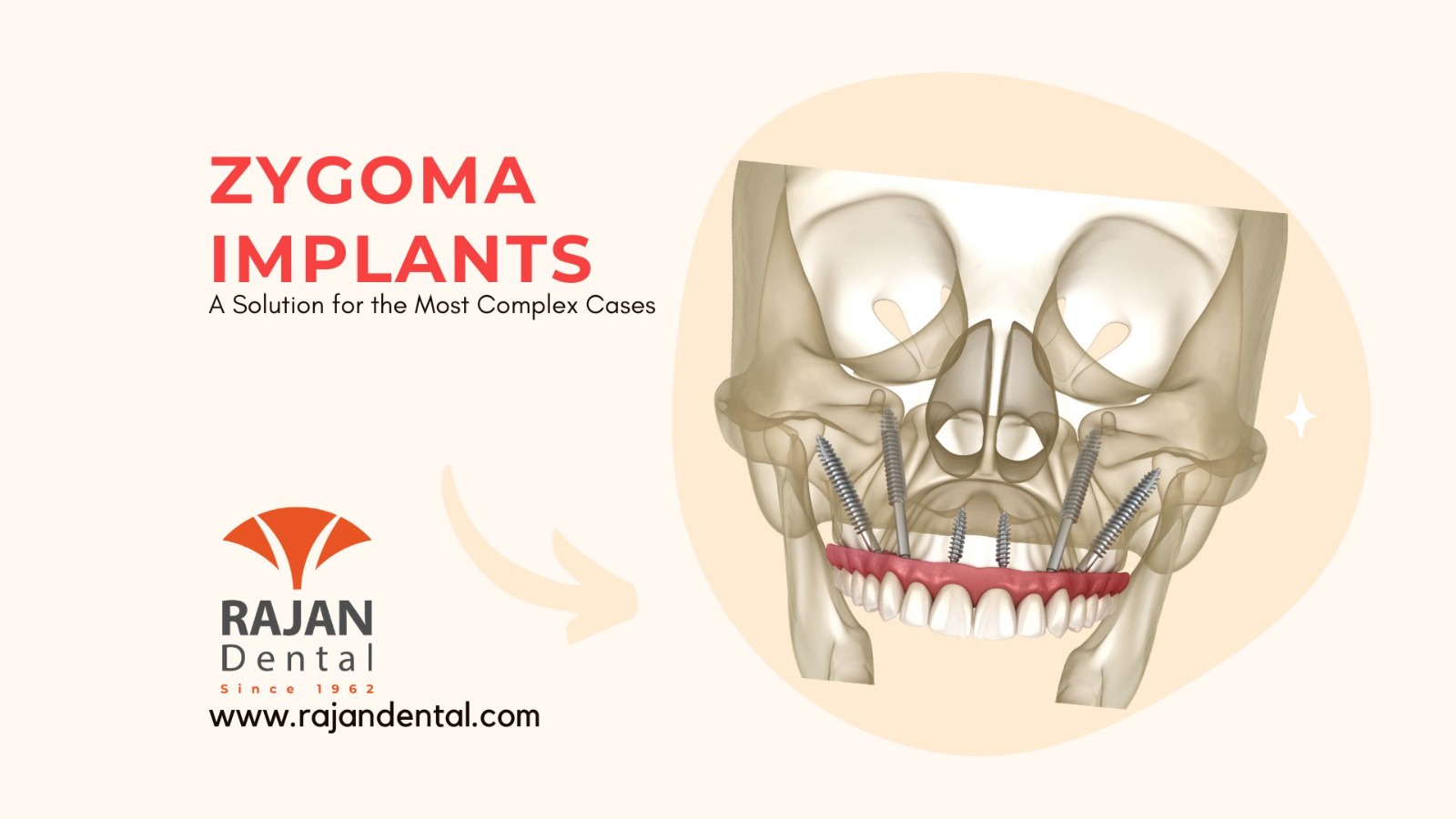 Zygoma Implants: A Solution for the Most Complex Cases