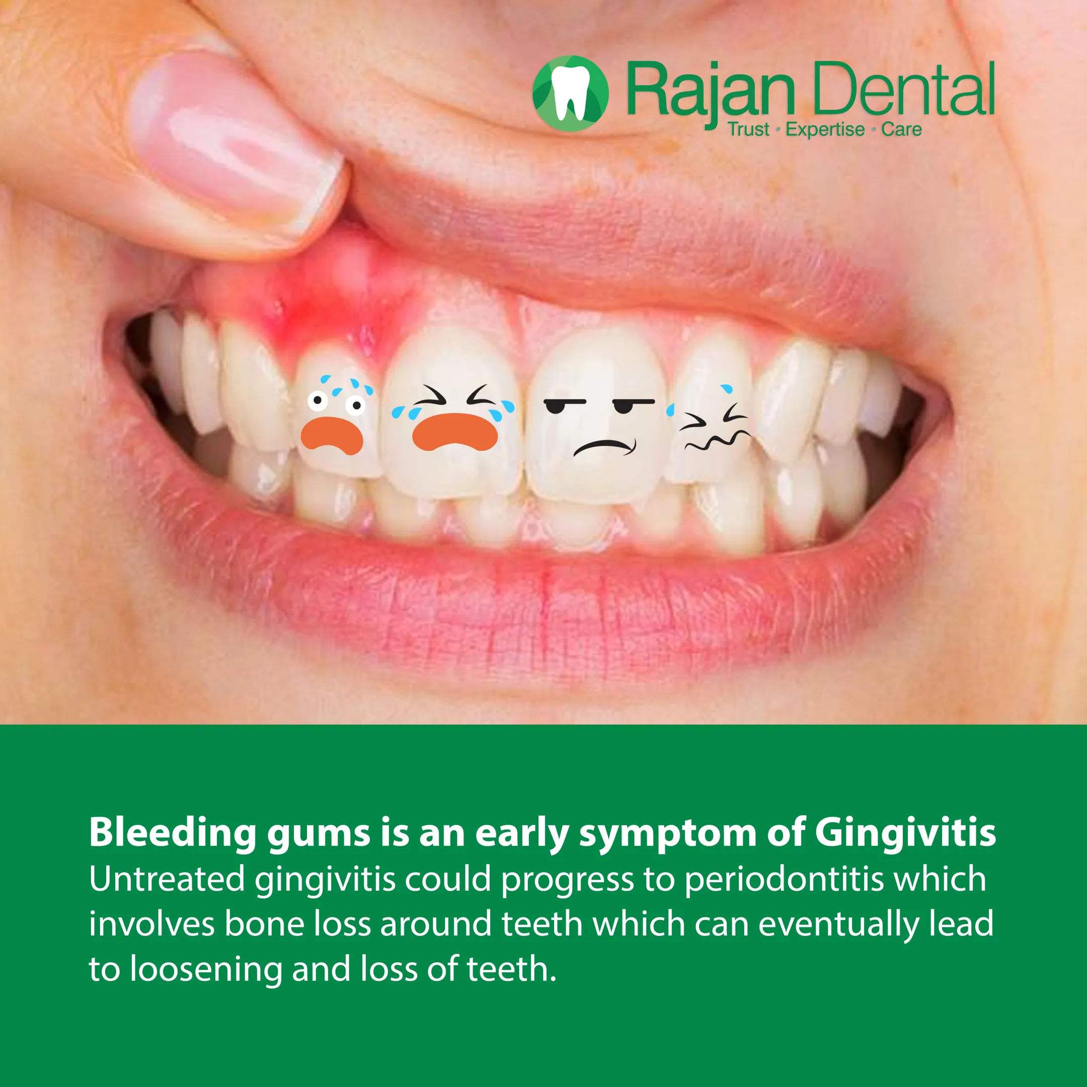 Oral Hygiene – Periodontics 1