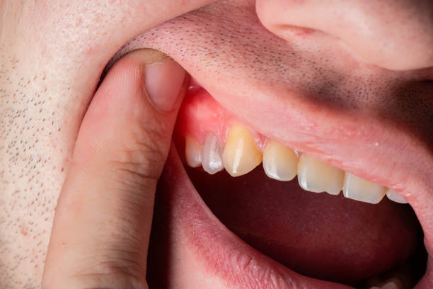 How to Manage Bleeding Gums