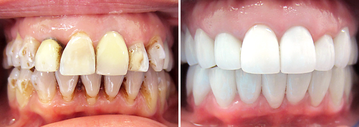 Rediscover Your Smile: Full Mouth Rehabilitation in Chennai