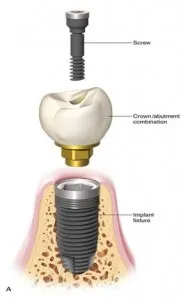 Screw Retained vs Cement Retained Implant Crowns