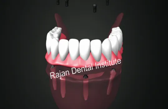 Treatment Timeline for All on 4 / Zygomatic Implants